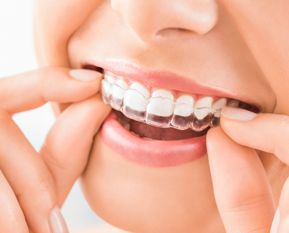 Invisalign & Clear Aligners