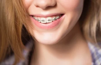 Close-up of a person smiling, showing metal dental braces on their teeth.