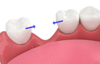 3d render of jaw bone recession after loosing tooth 