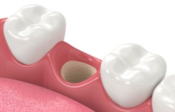 3D render of jaw with empty socket