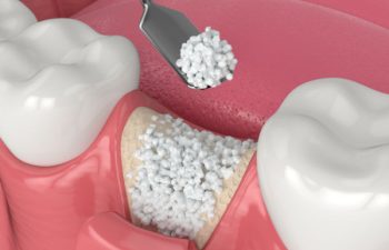 3D render of dental bone grafting with bone biomaterial application