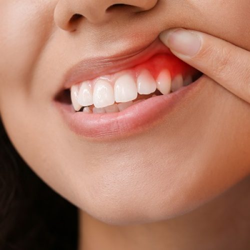 Woman,With,Gum,Inflammation,,Closeup